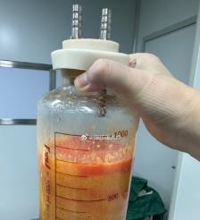 阳泉水动力吸脂手术要做多久？